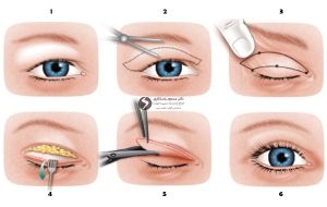 بلفاروپلاستی، بهبود ظاهر چشمان شما با جراحی زیبایی